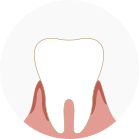牙垢及牙菌斑的堆積