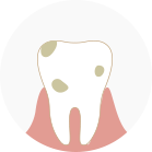 牙結石形成、牙齦損傷、刷牙流血、牙齦炎形成